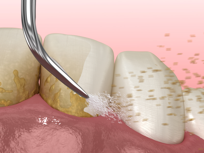 なるべく痛みを抑えたむし歯治療